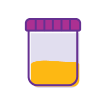 Urine collection cup with fluid inside, Urine Test, Harmony Head to Head Study, advanced melanoma, skin cancer